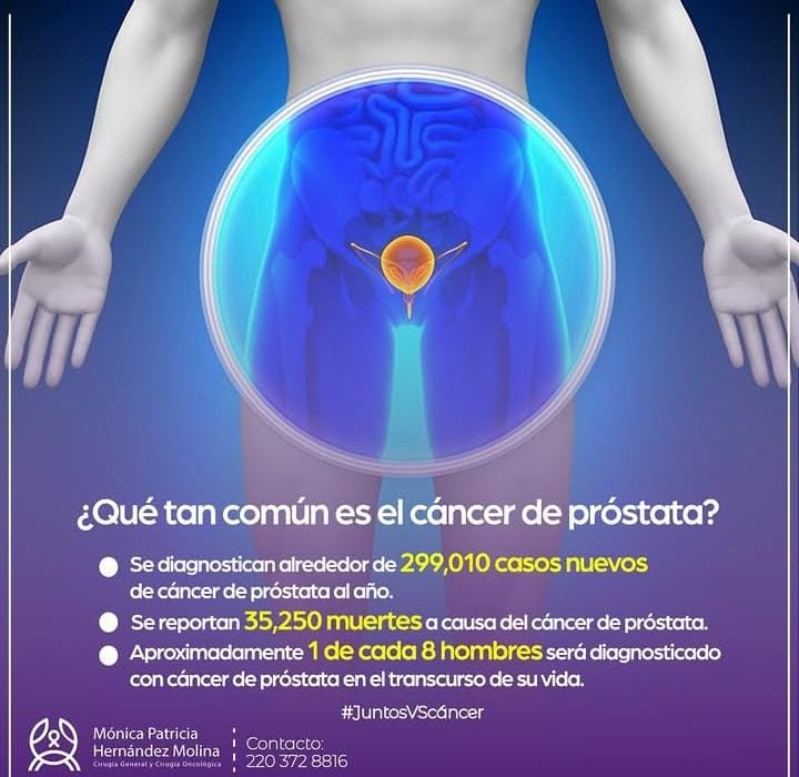 Infografía con cifras sobre qué tan común es el cáncer de próstata